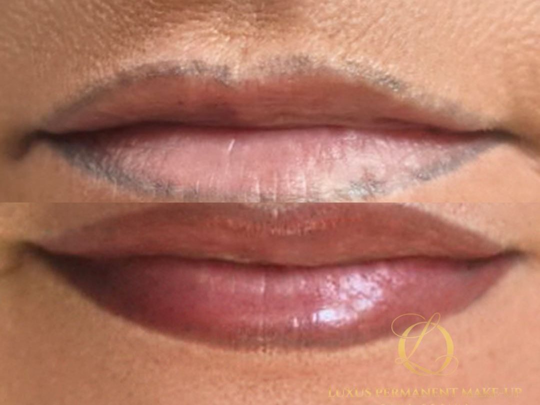 Vorher-Nachher: grau verfärbte Lippenkontur einer Fremdarbeit, korrigiert zu warmem Rosé