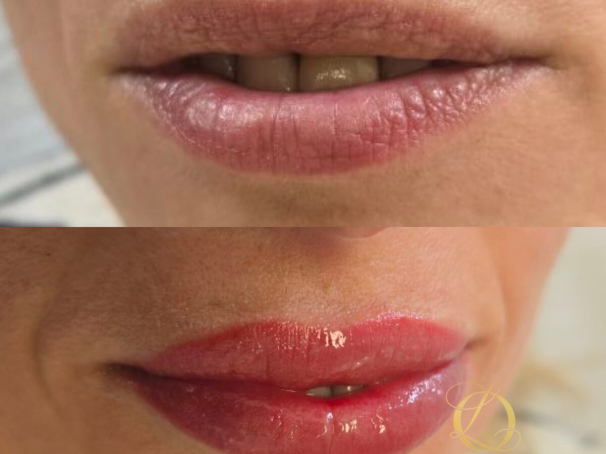 Vorher-Nachher: Lip Blush